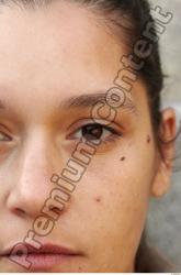 Eye Woman White Birthmarks Average